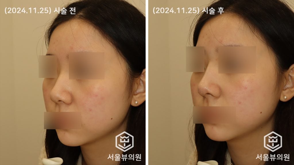 코 실리프팅2