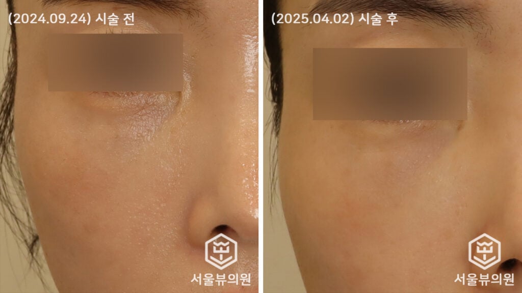 쥬베룩 리프팅 시술 전후사진