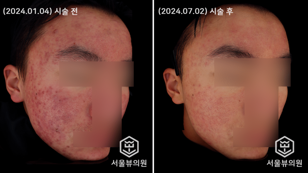 skin11