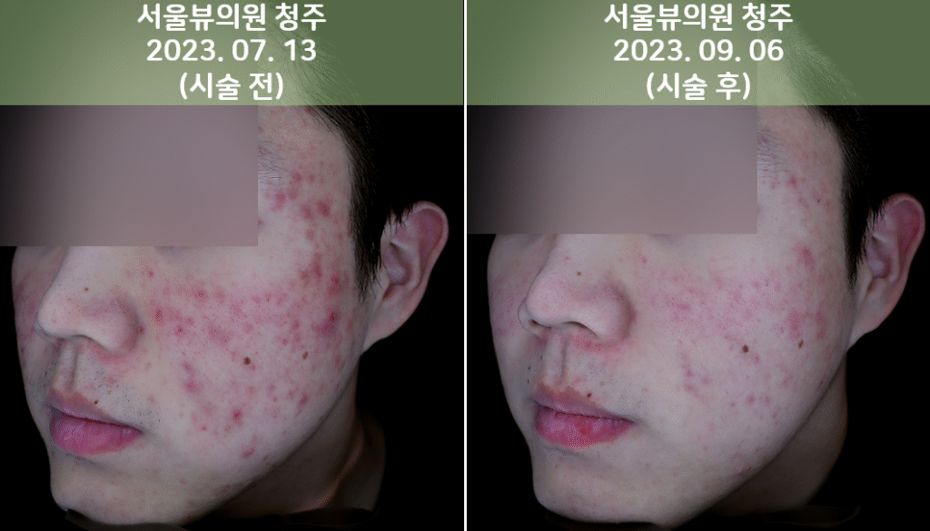 skin14