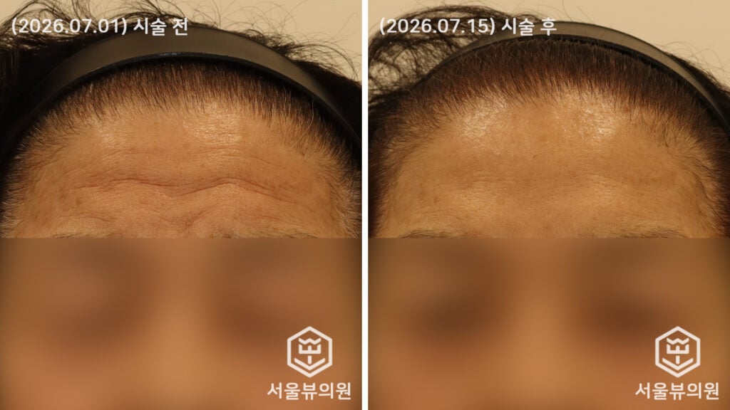 이마 잔주름 필러 시술 전후사진