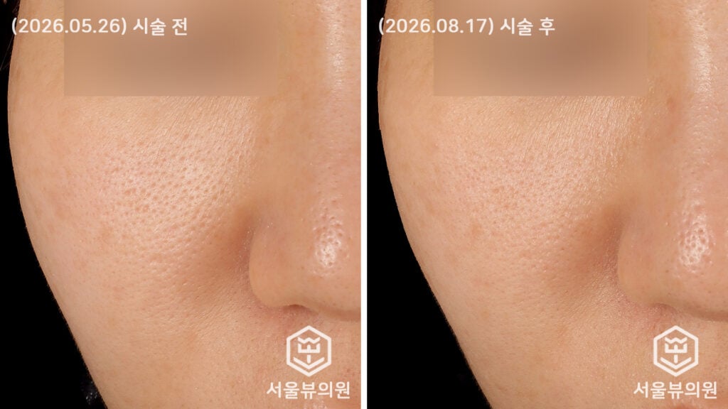 모공 흉터 시술 전후사진