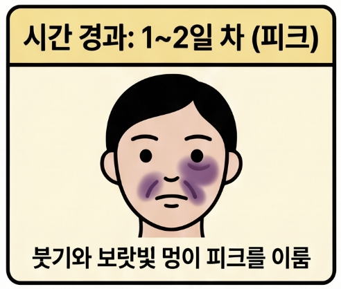 팔자주름 필러 후 붓기와 멍은 왜 생기나요? 3 붓기와 멍은 시기별로 어떻게 달라지나요?