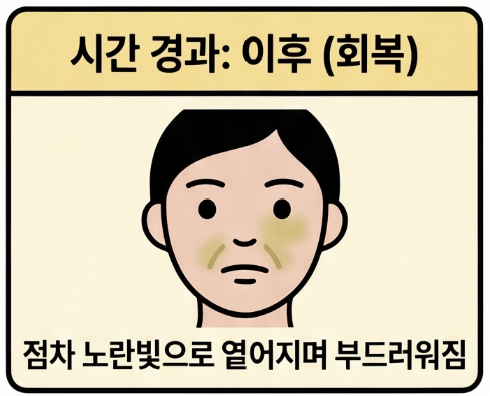 팔자주름 필러 후 붓기와 멍은 왜 생기나요? 4 붓기와 멍은 시기별로 어떻게 달라지나요?