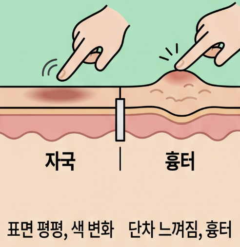 여드름 흉터 종류, 내 흉터는 어떤 유형일까요? 2 여드름 흉터 종류, 내 흉터는 어떤 유형일까요?
